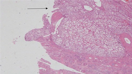Figure 1 Surgical margin without ink stain.