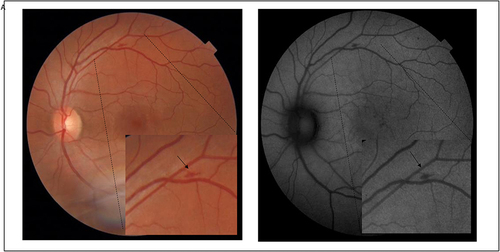 Figure 3 Main retinal findings patient 3 (A) Colour fundus photography and red-free imaging of the left eye of a male patient, without comorbidities and revealing a flame-shaped haemorrhage (black arrow). He had a mild condition, without hospitalisation.