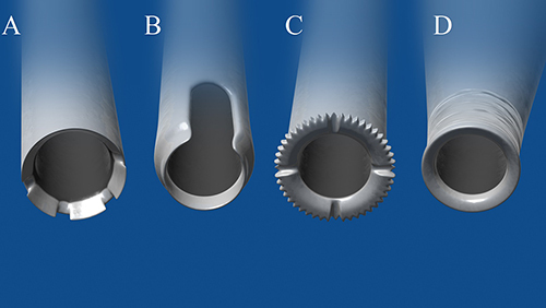 Figure 1 A recess-tipped asymmetric long-hair FUE punch featuring 4 notches (A). A recess-tipped punch showing an open slot (B). A flared serrated hybrid punch with 4 grooves cutting across its flat cutting tip, symmetrically located in each quarter of its circumference (C). The advanced hybrid Intelligent Punch® of the UGraft®, showing flaring, with no recess on its cutting edges or tips. There is texturing of the wall immediately proximal to the cutting edge (D).