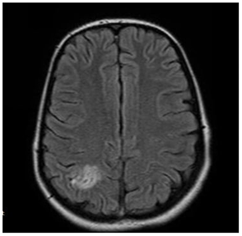 Figure 2 Magnetic resonance imaging FLAIR weighted image depicting subcortical hyperintensity in the right parietal lobe.