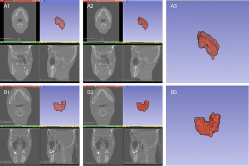 Figure 4 Reconstructed 3D image. (A1) Group A had immediate 3D reconstruction of the capsule after surgery. (A2) In group A, the volume of the capsule immediately after surgery was overlapped with the area of bone formation 6 months later. (A3) In group A, the translucent red area is the volume of the cyst immediately after surgery, and the internal dark red area is the new bone at 6 months.(B1) Group B had immediate 3D reconstruction of the capsule after surgery. (B2) In group B, the volume of the capsule immediately after surgery was overlapped with the area of bone formation 6 months later. (B3) In group B, the translucent red area is the volume of the cyst immediately after surgery, and the internal dark red area is the new bone at 6 months.