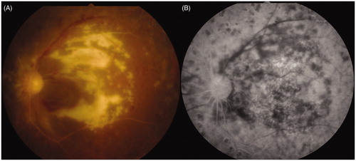 Figure 2. Fundus of left eye after treatment. (A) Macular color photograph and (B) macular fluorescein angiography. Ganciclovir therapy (600 mg/day) for 3 weeks achieved successful remission of the retinal lesion, but visual acuity of the left eye did not improve since macular atrophy had already progressed.