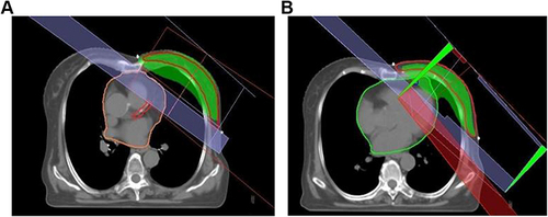 Figure 2 3DCRT planning in both modules: (A) 3DCRT planning in DIBH ABC gating, (B) with free breathing module.