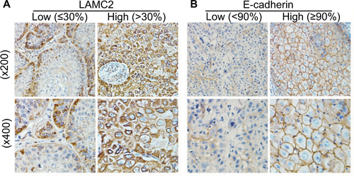 Figure S1 Immunohistochemistry assay for the expression of LAMC2 and E-cadherin in PSCC tissues. Note: Representative pictures.Abbreviations: LAMC2, laminin gamma 2; PSCC, penile squamous cell carcinoma.