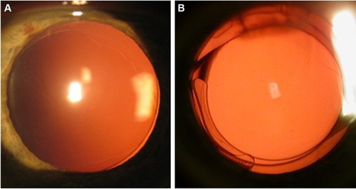 Figure 6 The slit-lamp retroillumination photos before (A) and 4 months after the IOL exchange (B).