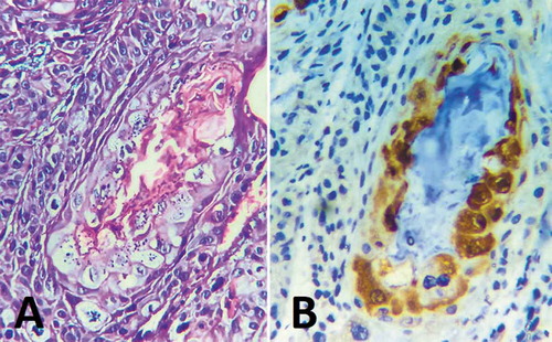 Figure 6. A: Photomicrograph showing moderately differentiated keratinized squamous cell carcinoma [H&E, original magnification x400], B: Photomicrograph showing positive cytoplasmic p16 staining via IHC of the same case [p16-INK4a, magnification x400].