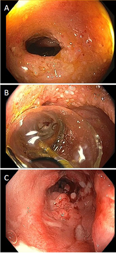 Figure 2 Ileocolonoscopy with inflammation and pseudopolyposis from the anal verge up to 20cm and terminal ileum stricture (A) requiring balloon dilatation (B) with successful dilatation (C).