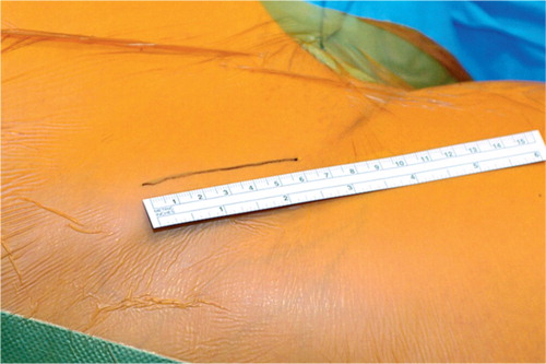 Figure 4. Minimally invasive trans-sartorial approach with only a 6 cm incision starting from the anterior superior iliac spine.