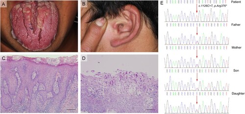 Figure 1. Clinical features and IL-17RC mutations in the present case. A. Tongue dorsum displayed deep fissures with unclear-bordered nodular hyperplasia, along with thickened white plaques with a granular surface on the stiffened dorsum and the lateral border. B. The patient had no typical cutaneous manifestations except for an erythematous plaque with adherent scaling on the antihelix. C. Histopathological examination of the lingual mucosa biopsy specimens revealed superficial mucosal hyperparakeratosis, inflammatory cell infiltration, and microabscess formation (magnification: ×100). D. The periodic acid–Schiff staining demonstrated fungal hyphae traversing perpendicularly through the surface epithelium up to the spinous cell layer (magnification: ×200). E. Sanger sequencing of the IL-17RC gene in family members of the patient: *arrows indicate the mutation sites.