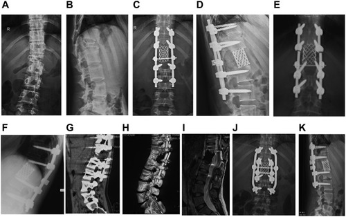 Figure 2 Typical Case 1: A 26-year-old female patient with L1 giant cell tumor of bone. (A and B) Positive and lateral X-ray films of the lumbar spine when the patient was admitted for the first time. Pathological fracture of the lumbar vertebra, noticeable compression of the vertebral body, and spine instability were observed. (C and D) X-ray films of the positive and lateral positions of the lumbar vertebrae after tumor resection. The L1 vertebral body was resected intraoperatively, showing good positive and lateral positions of the instrumentation. (E and F) Positive and lateral X-ray films with double rods broken 32 months after operation. Broken rods occurred at the upper edge of the titanium mesh, and the titanium mesh was embedded into the upper vertebral body. (G and H) The coronal plane of lumbar CT and 3D reconstruction shows broken rods and spinal instability. (I) No tumor recurrence s found on T2-weighted MRI of the lumbar vertebrae. (J and K) The positive and lateral x-ray film after revision, fixed with double rods during the operation.