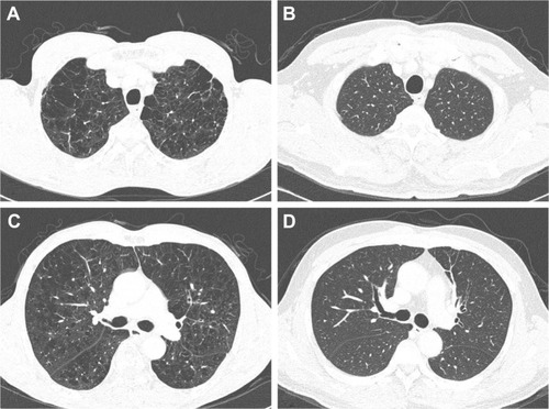 Figure 2 Comparison of CT images of two subjects with high emphysema score and low emphysema score.