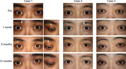 Figure 2 Case 1: The right eye was treated. Before treatment, upper eyelid swelling, scleral show and a lack of an upper eyelid sulcus were evident in the right eye. Upper eyelid sulcus (arrow) slightly appeared 1 month after the injection. At 6 months, the scleral show and eyelid bulge resolved. At 12 months, no features of upper eyelid retraction and swelling were observed. Subcutaneous white particles of TA (arrowhead) were observed at 1 and 6 months. These were not detectable right after injection. The particles were not visible at 12 months. Case 2: The left eye was treated. Before treatment, scleral show, upper eyelid swelling and lack of an upper eyelid sulcus were evident in the left eye. At 1 month after treatment, a slight upper eyelid sulcus (arrow) could be detected. At 6 months, the scleral show and palpebral fissure height reduced. At 12 months, the scleral show resolved. Case 3: Both eyes were treated. Before treatment, scleral show, bulging eyelids and lack of an upper eyelid sulcus were evident in both eyes. At 1 month after treatment, the eyelid bulge reduced. At 6 months, the scleral show resolved and the palpebral fissure height reduced. At 12 months, the eyelid bulge resolved, although the upper eyelid sulcus was still not observable.