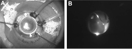 Figure 8 LiDrape® in 23-gauge vitrectomy. (A) The surgical field was limited due to the presence of cannulas, closure valves, and a chandelier light. (B) The novel device remained attached to the eye during scleral indentation under a wide-angle viewing system.