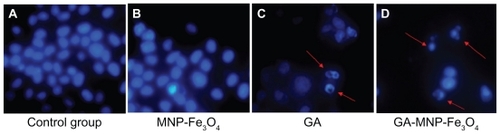 Figure 4 Nuclear morphologic changes of the Capan-1 pancreatic cancer cells after different treatment for 48 hours. (A) untreated cells as control, (B) MNP-Fe3O4, (C) GA alone, and (D) GA-loaded MNP-Fe3O4.Notes: The concentrations of GA and MNP-Fe3O4 are 1 μmol/L and 20 μg/mL, respectively. Magnification folds ×400. Arrows indicate cells with apoptotic nuclear condensation and fragmentation.Abbreviations: GA, gambogic acid; MNP-Fe3O4, magnetic Fe3O4 nanoparticles.