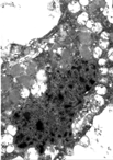Fig. 4 Autoptic frontoparietal cortex. Collections of granular osmiophilic deposits (GRODs) in the neuronal cytoplasm. TEM. Original magnification, × 6,000.