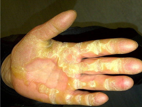 Figure 1. Striate palmoplantar keratoderma associated with an autosomal dominantly inherited loss of function mutation in DSG1.