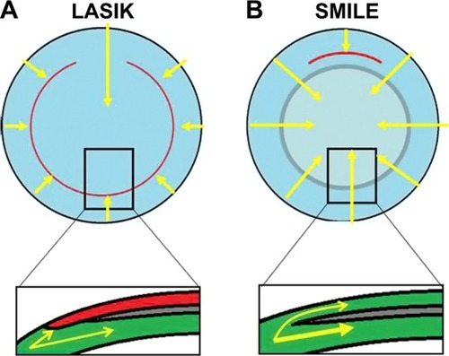 Figure 4 Corneal nerves (arrows) in LASIK (A) and SMILE (B).