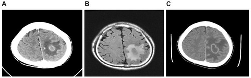 Figure 1 (A) Computed tomography scan at admission showing a brain mass with edema of the peripheral white matter in the left parietal lobe. (B) Brain MRI T2-flair revealed a mass in the left parietal lobe measuring approximately 23 mm × 17 mm, with irregular central necrosis and edema of the peripheral white matter. (C) Brain computed tomography scan obtained two days after admission showing a mass in the left parietal lobe, approximately 32 mm × 22 mm, with central cystic change, ring-like enhancement, and edema of the peripheral white matter.