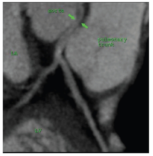 Figure 3 Curved multiplanar reformat of computed tomography coronary angiography demonstrating the anomalous left main coronary artery (green arrows) arising from the right coronary cusp then traversing between the aorta and the pulmonary trunk before bifurcating into the left anterior descending and circumflex arteries. LA (left atrium), LV (left ventricle).