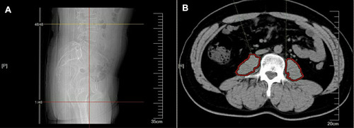 Figure 2 Computed tomographic images at the the middle third lumbar vertebral level. (A) Sagittal map. (B) Cross-sectional image and red circle shows the outline of psoas.
