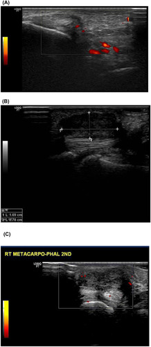 Figure 1 (AC) Musculoskeletal ultrasound finding of one patient in the current study. (A) longitudinal axis power Doppler US view of the palmar aspect of wrist joint shows increased joint space with hyperemia denoting synovial inflammation, (B) short-axis power Doppler US view (C) longitudinal axis grayscale US view of the volar aspect of 2nd Metacarpal pharyngeal Joint shows periarticular hyper-vascularization denoting synovitis with distention of the adjacent adventitial bursa measuring 1.6x0.7 cm.