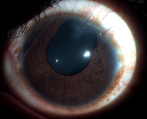 Figure 2 Slit-lamp photograph of the anterior segment 1 week postoperatively showing the sectoral surgical iridectomy.