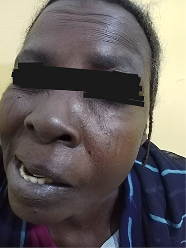 Figure 1 An incomplete left eye closure and a right-sided mouth deviation (Bell’s palsy) following COVID-19 infection.