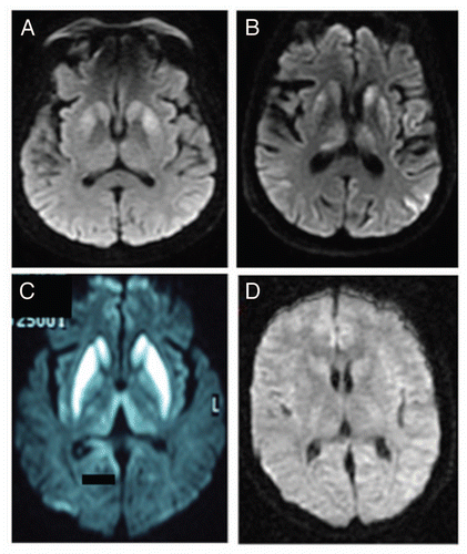 Figure 1 Bilateral hyperintensities of the basal ganglia in case 1 (A), 4 (B) and 7 (C), compared to a normal control (D).