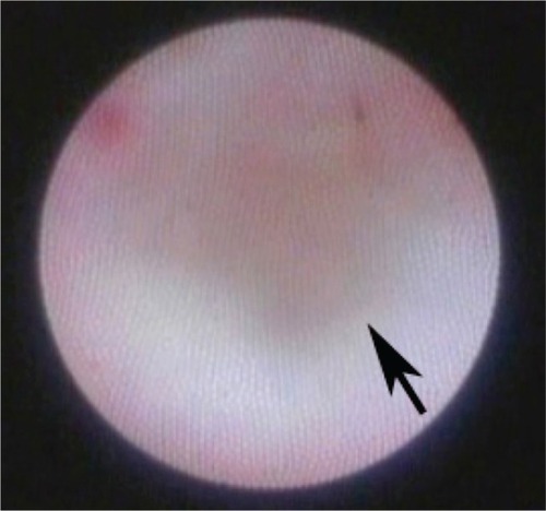 Figure 2 Dacryoendoscopic image of the lacrimal sac. The wall of the lacrimal sac is smooth with no fibrosis. There is a dimple (arrow) in the lacrimal sac.
