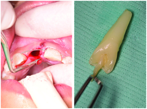 Figure 2. Removal of the cloth and cleaning of the alveolus; pulpal aspect of the URCI before endodontic treatment.