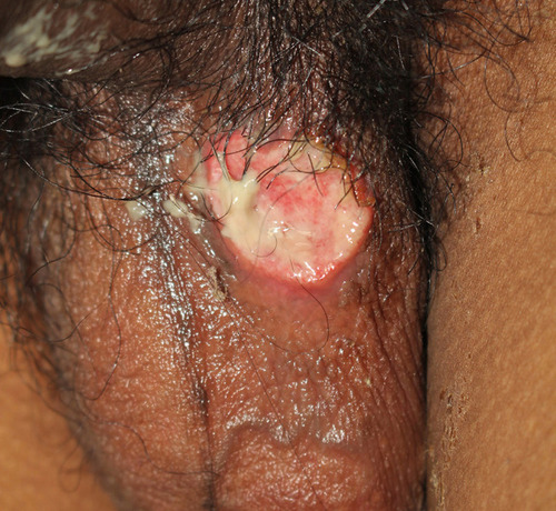 Figure 5 A recurrent genital ulcer on the scrotum.