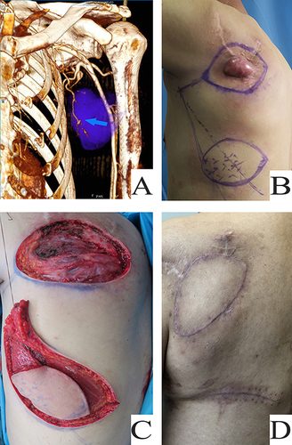 Figure 3 Case 2. A 66-year-old male patient had a recurrent malignant neurilemmoma in the left shoulder. TAPcp flap was used to repair the defect after tumor resection. The donor site was sutured directly. (A) CTA showed the thoracodorsal artery and its branches patency (Blue arrows showed the branch of the thoracodorsal artery). (B) The tumor and the design of flap was shown. (C) The tumor was excised and the flap was harvested. (D) The flap survived well and donor site was closed directly.