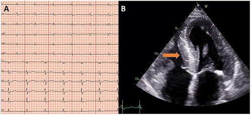 Figure 3. Electrocardiographic and echocardiography (apical 4-chamber view) images showing low voltage QRS (A) and huge left ventricular hypertrophy (B), arrow pointing towards interventricular septum) in a study participant with amyloidosis.