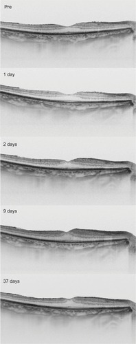 Figure 4 The horizontal cross-sectional swept-source optical coherence tomography images at each visit.