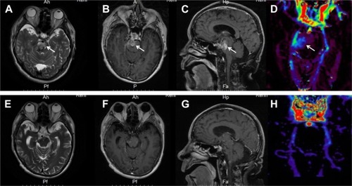 Figure 1 Brain MRI scans.Notes: MRI before treatment (A–D): (A) axial T2W shows a hyperintense signal alteration in the right side of the pons; (B) axial T1W post-contrast; (C) sagittal T1W post- contrast; and (B and C) increased enhancement within the tumor. (D) 3D-ASL CBF shows increased CBF value in the right pons. MRI after treatment (E–H): (E) axial T2W shows a decreased hyperintense signal in the right side of the pons compared to pretreatment; (F) axial T1W post-contrast; (G) sagittal T1W post-contrast; and (F and G) disappeared right pontine lesion. (H) 3D-ASL CBF shows decreased CBF value in the right pons compared to pretreatment.Abbreviations: 3D-ASL, three-dimensional arterial spin labelling; CBF, cerebral blood flow; T1W, T1 weighted; T2W, T2 weighted.