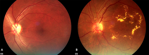 Figure 1 Gradable retinal images taken during the study; (A) no diabetic retinopathy; (B) referral-warranted diabetic retinopathy with clinically-significant macular edema.
