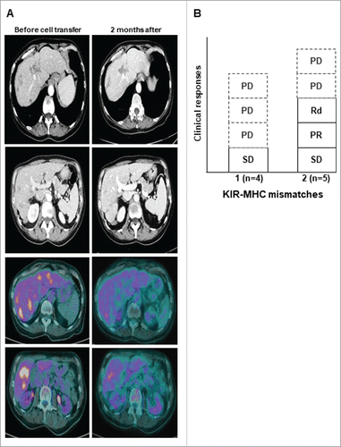 Figure 3. Clinical activity. A Representative tumor responses evaluation by CT-scan and PET-scan before (left) and after (right) 2 months of NK cell transfer in patient 6 (PR). B, Objective responses according to the number of KIR ligand mismatch. PD, progressive disease; PR, partial response; Rd, dissociated response; SD, stable disease.