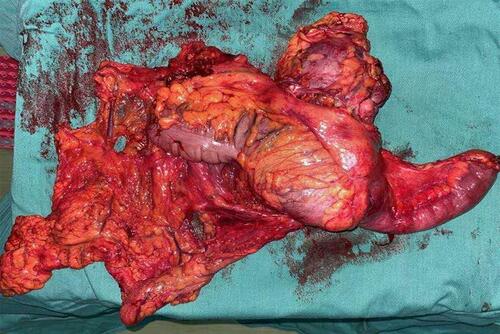 Figure 6 Resection samples of intestines and kidneys.