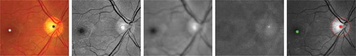 Figure 3. An example of the proposed optic disc (OD) and fovea detection. From Columns 1 to 5: original colour fundus image with manually annotated OD (black star) and fovea (white star), normalised green channel, Gaussian blurred image, PSEF response, and maximum response of PSEF indicating the OD location (red star) and the corresponding detected fovea (green star).