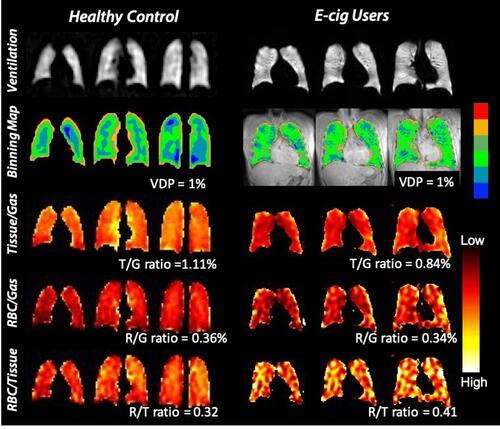 Figure 1 Representative ventilation and gas-exchange MRI with quantitative maps for a healthy control (FEV1% =103%, FVC%=109%) and an asymptomatic e-cigarette user (FEV1% =104%, FVC%=106%, %DLCO=103%). The first row shows ventilation scans (brighter appearance represents better-ventilated areas). For the quantitative ventilation maps (second row) of the young, healthy control vs the e-cigarette subject, VDP (areas without any ventilation) was 1% vs 1%. The third through fifth rows show the three gas-exchange ratios: Tissue-to-Gas (T/G, third row), RBC-to-Gas (R/G, fourth row), and RBC-to-Tissue (R/T, fifth row) ratios, where red indicates low gas exchange and yellow indicates high gas exchange. For the quantitative gas exchange maps of the young, healthy control vs the e-cigarette subject, T/G ratio was 1.11% vs 0.84%, R/G ratio 0.36% vs 0.34%, and R/T ratio 0.32 vs 0.41.