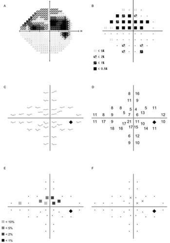 Figure 1 Measured results of glaucoma patient (67-years male, primary open-angle glaucoma, Mean deviation –8.90 dB, Pattern standard deviation 8.83 dB, Visual field index 74%). (A) Gray scale of Humphrey Field Analyzer (HFA), (B) Pattern deviation of HFA, (C) Pupil waveforms, (D) Percentage pupil constriction (%), (E) Pattern deviation (■25% black; P<10%, ■50% black; P<5%, ■75% black; P<2%, ■100% black; P<1%), (F) Subjective response (It can be simultaneously recorded if the patient pushes a button).
