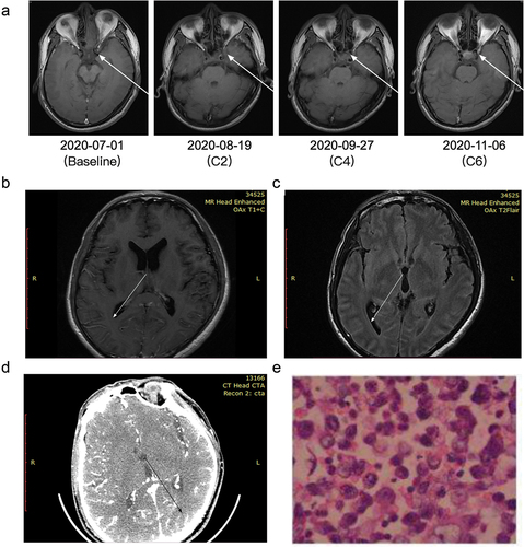 Figure 2. (a) Changes in target lesions by nasopharyngeal MRI every 2 cycles during first line chemoimmunotherapy; (b) Leptomeninges strengthening on T1WI enhancement; (c) Blurred sulcus on T2FLAIR. (d) Linear reinforcement in the sulci on CTA. (e) Cerebrospinal fluid cytology: cerebrospinal fluid smear and sediment paraffin-embedded sections showed large nuclei, deep staining, and a high nucleoplasm ratio, considering the possibility of cancer cells. Immunohistochemical results: heteromorphic cells CK (+), P63(+), Ki-67 (about 40%), CD20(-), CD3(-), consistent with squamous cell carcinoma.