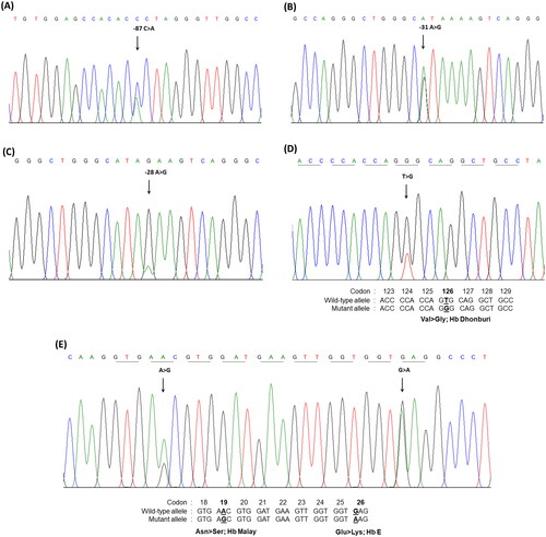 Figure 2. The molecular characterization of the β-globin gene performed by DNA sequencing. Mutations in the promotor region of β-globin gene; (A) nt-87(HBB:c.-137C>a), (B) nt-31(HBB:c.-81A>G), (C) nt-28(HBB:c.-78A>G), (D) Hb Malay (beta 19(B1) Asn>ser; HBB:c.59A>G), and (E) Hb Dhonburi (beta 126(H4) Val>gly;HBB:c.380T>G).