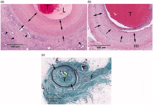 Figure 12. Representative illustrations of HIFU lesions in vascular tissue. (a) H&E-section of a vein extracted 30 days after treatment. HIFU lesion shows vein wall hyalinization (arrows), thrombus (T) and necrotic perivascular adipose tissue (arrowheads). (b) H&E-section of a vein extracted at 60 days. Thrombus (T), fibroblast infiltration (double arrows) and residual media hyalinization (arrows) are observed. (c) GET-section of a vein extracted at 90 days and presenting fibrocellular thrombus (T), media fibrosis (arrows) and perivascular fibrosis (F).