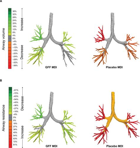 Figure 4 Changes in specific image-based: (A) airway volume and (B) airway resistance at Day 15, after treatment with GFF MDI or placebo MDI. Adapted from International Journal of COPD 2018:13 2673-2684 – Originally published by and used with permission from Dove Medical Press Limited.Citation56 Images from one representative patient.