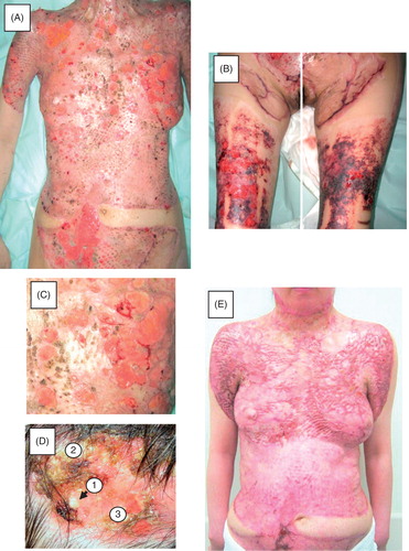 Figure 2. Clinical course after the second admission. A and B: Initial appearance on the second admission. Multiple recurrent ulcers are scattered in the grafted skin (A) and donor sites (B). C: Close-up view of the recurrent ulcers. D: Progression of the lesions. The lesions started as pustules (1), which then transformed to form a crust (2). When the crust was removed, a fresh ulcer appeared (3). E: Recent appearance of the patient after treatment with oral corticosteroids. The ulcers were restricted to limited areas; no ulcers are seen in this field.