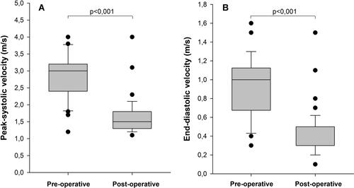 Figure 5 Changes in the transabdominal duplex ultrasound flow velocities before and after the laparoscopic decompression of the CA in 52 patients with median arcuate ligament syndrome. (A) Peak systolic velocity (PSV); (B) end-diastolic velocity (EDV). Boxes represent the interquartile range with the median as a horizontal line compared with the Mann–Whitney U-test.