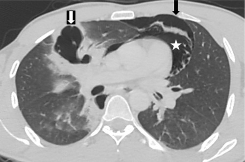 Figure 3 A 33-year-old man who had a motor vehicle crash had right lung laceration (white arrow) and surrounding contusion.