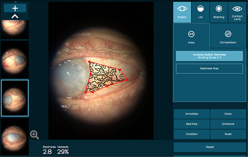 Figure 3 An example of temporal bulbar conjunctival inflammation score measurement followed by marking the desired area using the area tool.