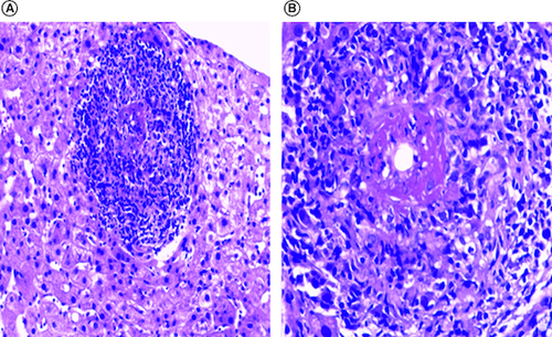 Figure 1. Histological findings.Microscopic features of liver biopsy demonstrated granulomatous necrotizing vasculitis (H&E staining X200 (A) and X400 (B)).